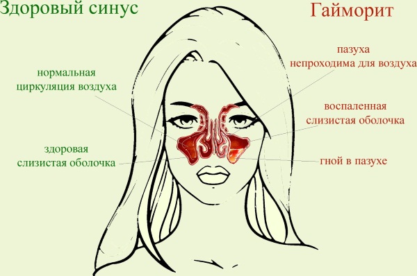 Антистрептолизин-О (АСЛ-О) повышен. Что это значит, причины, норма у детей, женщин, лечение