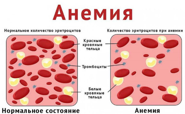 Неизмененные эритроциты в моче. Что это значит, повышены, причины, норма