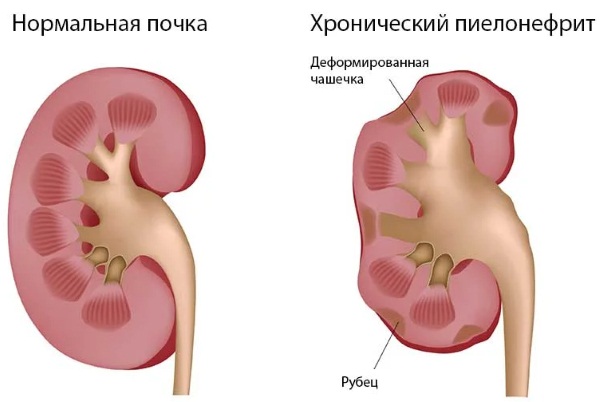 Красная моча у женщины. Причины боли, после 40-50 лет, с осадком, сгустки, при беременности