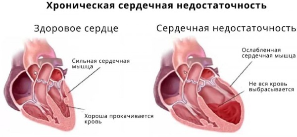 Нарушение внутрижелудочковой проводимости на ЭКГ у ребенка, подростка, взрослых. Что это значит