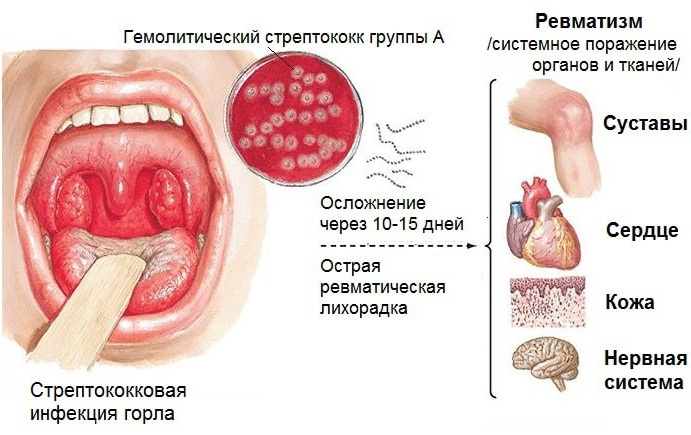 Антистрептолизин-О (АСЛ-О) повышен. Что это значит, причины, норма у детей, женщин, лечение