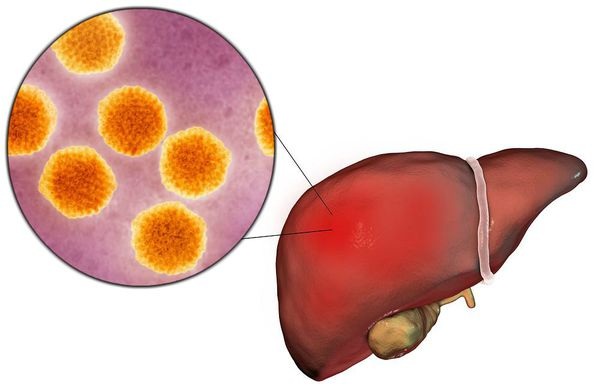 Гепатит А. Как передается от человека к человеку, чем опасен, симптомы и лечение