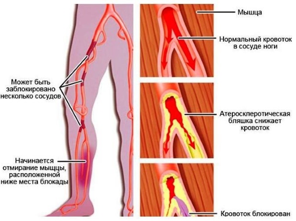 Атеросклероз сосудов нижних конечностей. Лечение народными средствами, препаратами, симптомы, диета