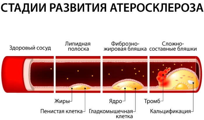 Атеросклероз сосудов нижних конечностей. Лечение народными средствами, препаратами, симптомы, диета