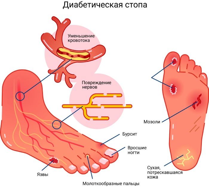 Диабетическая стопа. Что это, уход за ногами при диабете, лечение, классификация, рентген