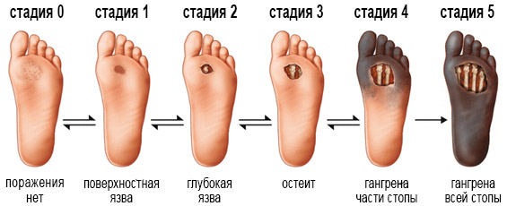 Диабетическая стопа. Что это, уход за ногами при диабете, лечение, классификация, рентген