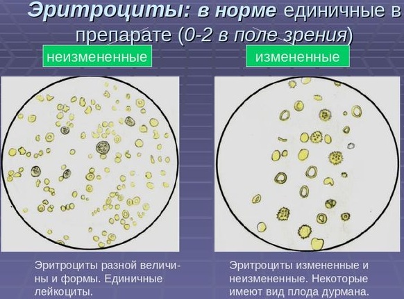 Неизмененные эритроциты в моче. Что это значит, повышены, причины, норма