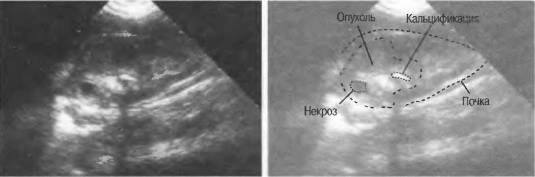 Как выглядят опухоли на узи