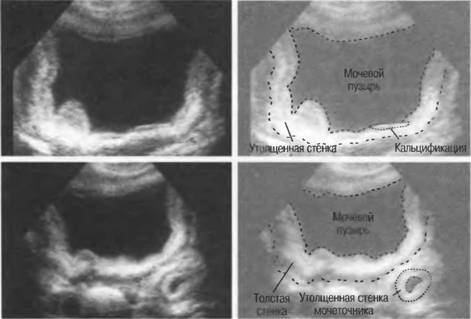 Утолщение стенок. Отслойка слизистой мочевого пузыря УЗИ. Отслоение слизистой мочевого пузыря на УЗИ. Утолщение стенки мочевого пузыря на УЗИ. Отслоение стенок мочевого пузыря УЗИ.