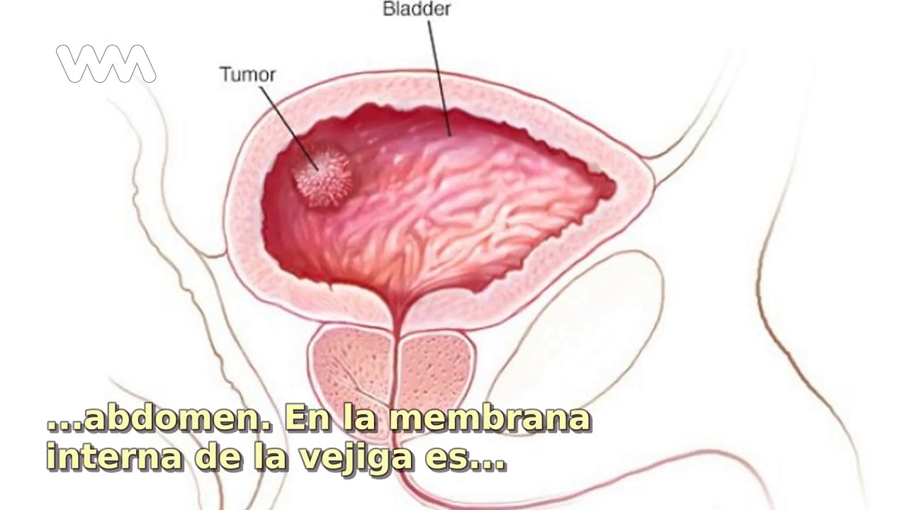 Опухоль мочевого пузыря у мужчин. Эндометриоз мочевого пузыря. Эндометриозтмочевого пузыря.. Фибромиксома мочевого пузыря.