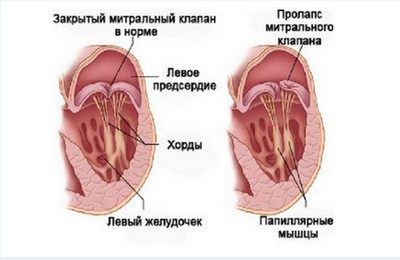 Пролапс митрального клапана 2 степени