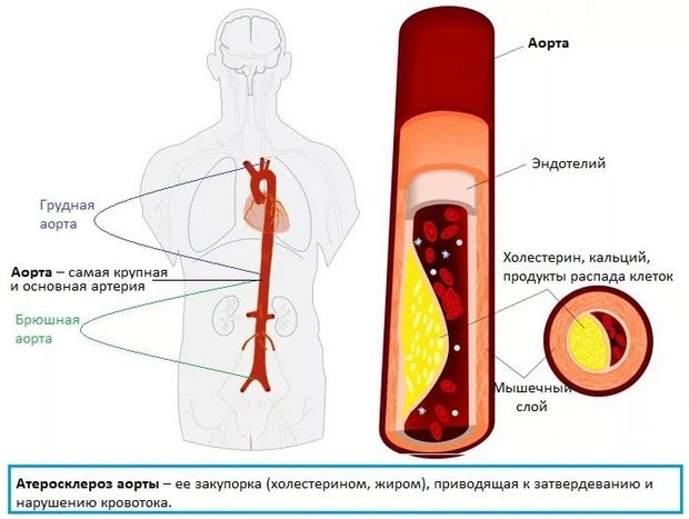 склерозирование аорты