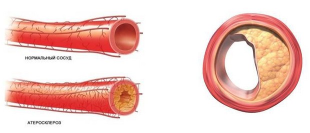 атеросклероз синдром лериша