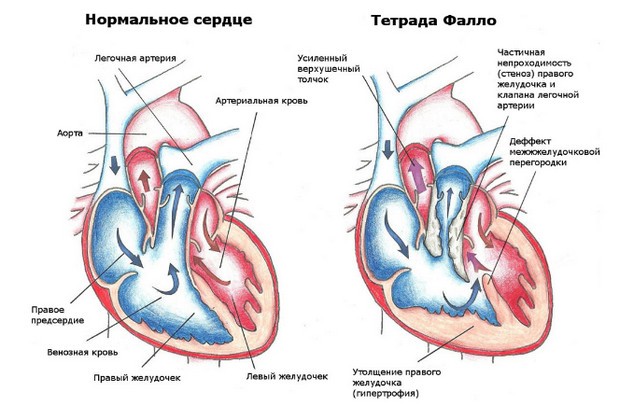 тетрада Фалло симптомы