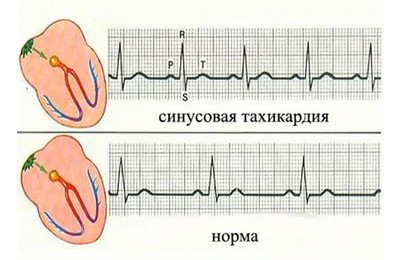 синусовая тахикардия