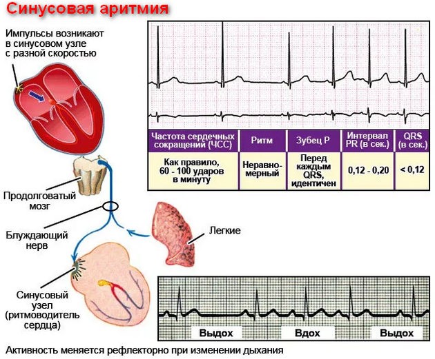 синусовая аритмия что это