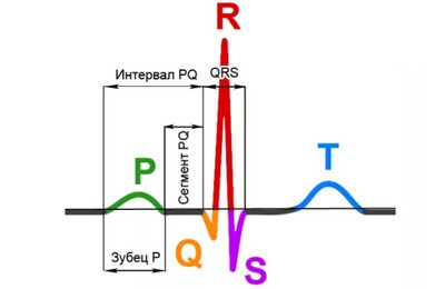 синусовая аритмия на ЭКГ