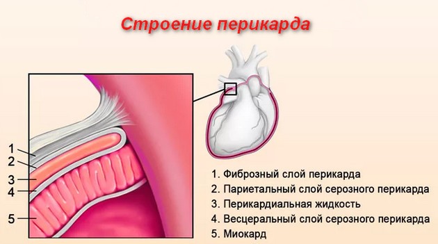 перикардит сердца