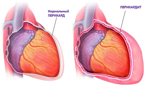 что такое перикардит