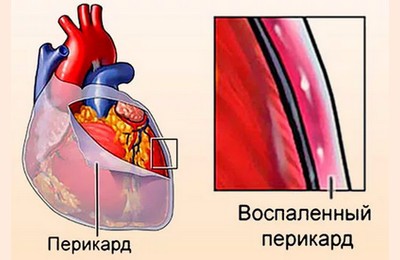 причины перикардита