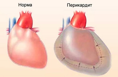 экссудативный перикардит