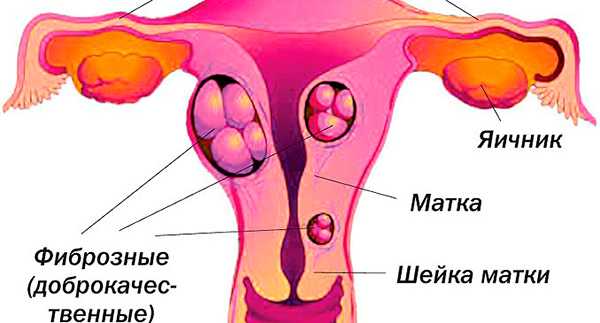 Фиброз матки что это