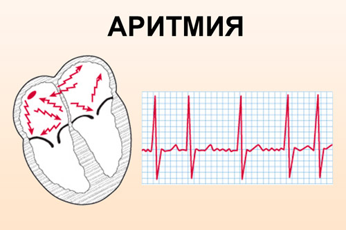 Сердечная аритмия. Аритмическая форма ИБС. Аритмия картинки. Ритм и аритмия. Аритмия сердца рисунок.