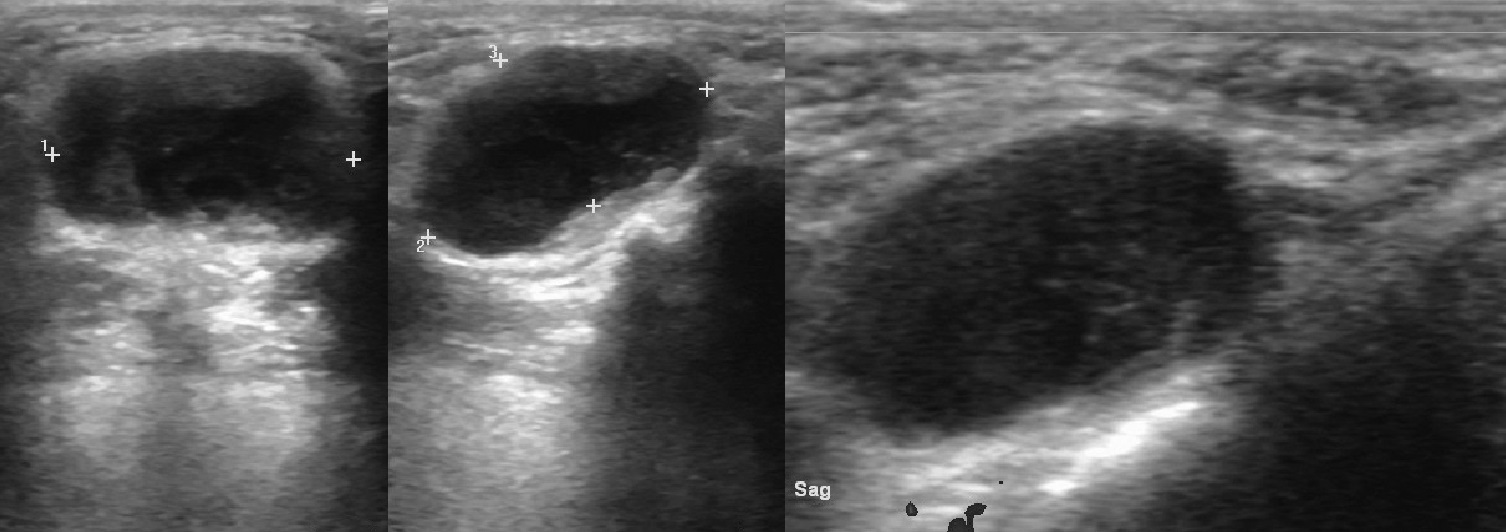 Эктопия щитовидной железы. Киста щитовидной железы на УЗИ. Срединная киста шеи на УЗИ. Эпидермоидная киста УЗИ. Коллоидная гиперплазия щитовидной железы УЗИ.