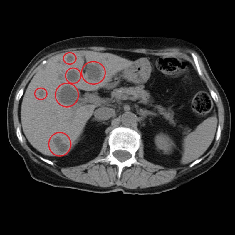 Как выглядят метастазы в печени на кт с контрастом фото