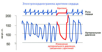 ЭКГ при аритмии