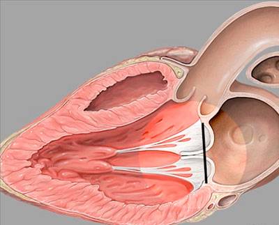 Выбухание створок митрального клапана