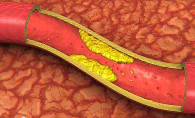 Атеросклеротическая бляшка внутри сосуда