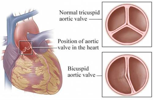 Варианты клапанов аорты