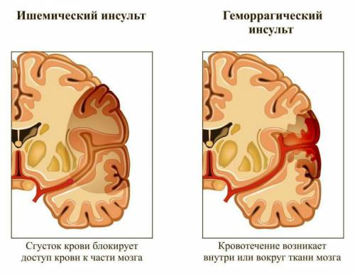 Ищемический и геморрагический инсульт