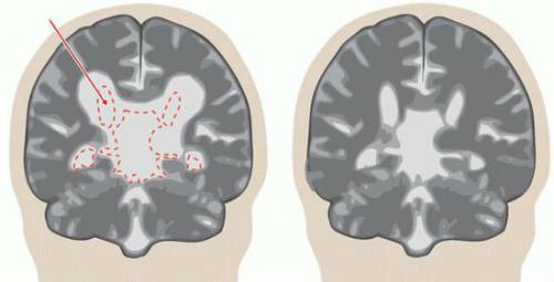 Расширение желудочков мозга