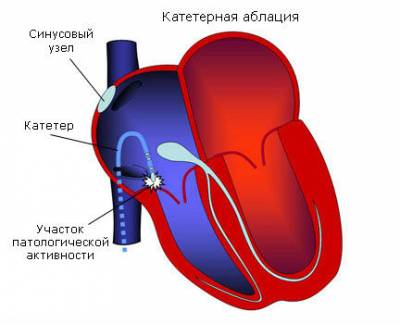 Катетерная абляция сердца