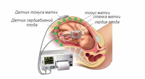Кардиотокография