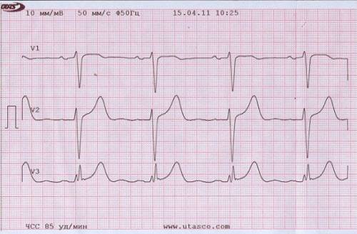 Электрокардиограмма