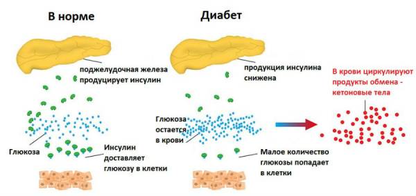 Развитие сахарного диабета