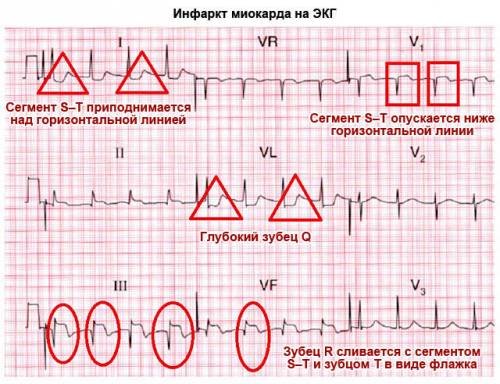 Инфаркт миокарда