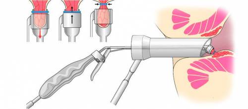Операция при геморрое