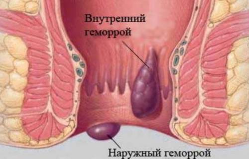 Геморрой