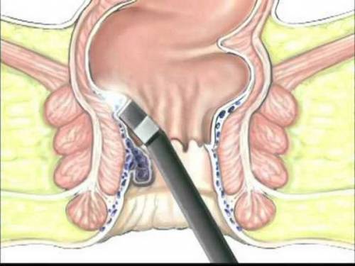 Операция при геморрое