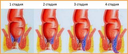 Стадии геморроя