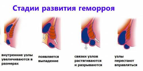 Стадии геморроя