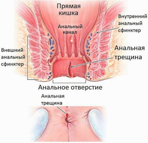 Анальная трещина