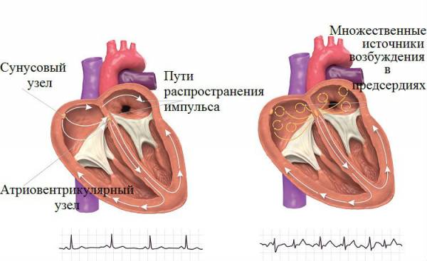 Мерцательная аритмия