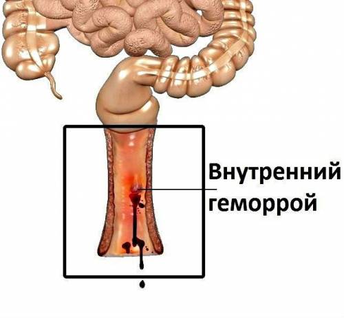 Внутренний геморрой