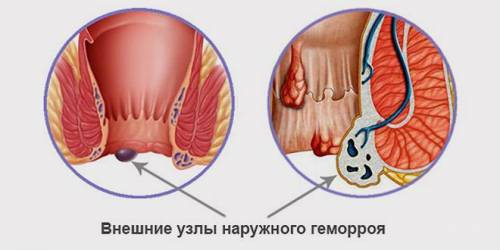 Внешний геморрой