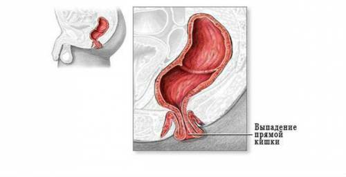 Выпадение прямой кишки